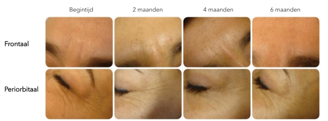 Voor en Na gebruik Advance 24h Crème 